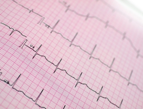 Insuffisance cardiaque : mortalité en baisse de 30 % en 10 ans