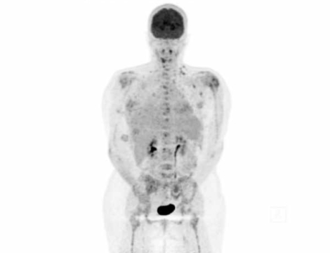 Cancer : journée mondiale le 4 février