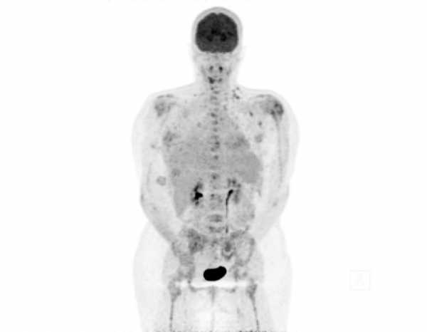 Cancer : journée mondiale le 4 février