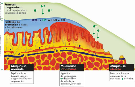 Savoir la patho : L’ulcère gastroduodénal