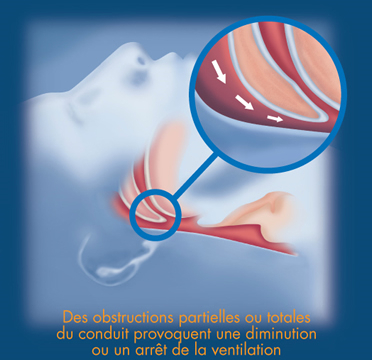 Le syndrome d’apnée du sommeil