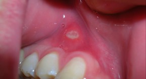 Ulcère de la bouche : effet accru avec certains antipsychotiques