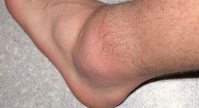 Percutalgine : les ampoules et le gel sont de retour