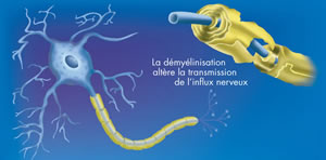 La sclérose en plaques