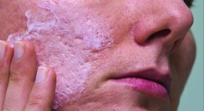 Maladies de peau : 30 % des Français concernés