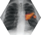 © ARMPL_C2_CO-CancerPoumon.qcd-60-image_I1