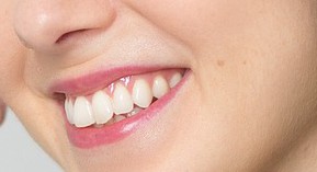 Fluocaril gel 2000 et Fluodontyl : repris par Tradiphar