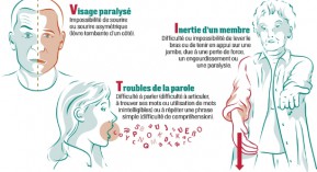 AVC : savoir repérer et agir