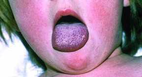 Epidémie de scarlatine en Angleterre : conseils de prévention