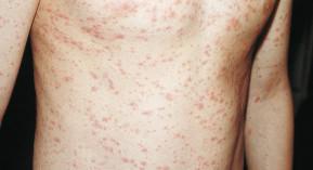 Rubéole : déclaration obligatoire