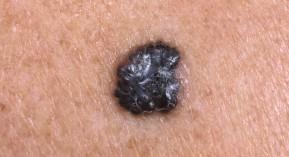 Cancers cutanés : l’Anses recommande de fermer les cabines de bronzage artificiel