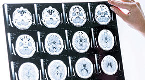 Androcur et génériques : une IRM pour tous les nouveaux patients