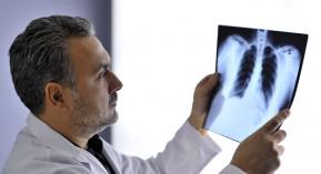 Cancer du poumon : vers un dépistage organisé ?