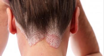 Daivonex crème : le retour