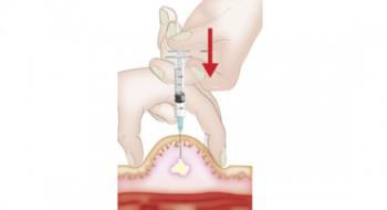 Formation : mode d’emploi de l’auto-injection d’héparines
