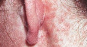 Rougeole : 244 cas depuis le 1er janvier 2019