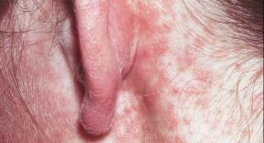 Rougeole : 350 cas déclarés depuis le 1er janvier