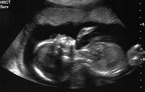 IVG médicamenteuse en ville : les mesures officinales se pérennisent