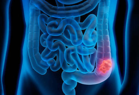 Dépistage du cancer colorectal : boostez la participation !