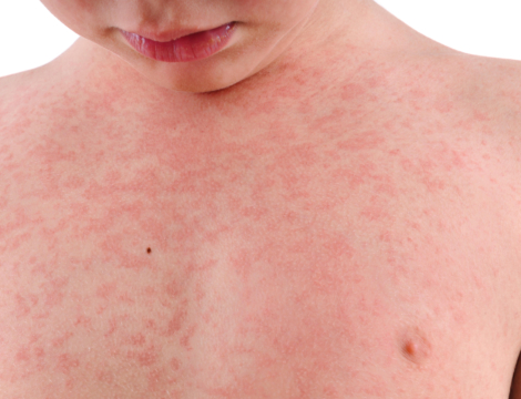 Rougeole : données rassurantes en France pour 2021, mais en 2022…