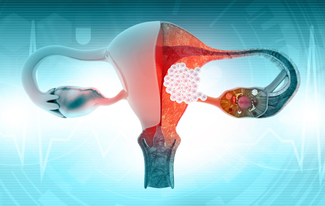 HPV : une seule dose de vaccin suffirait-elle ?