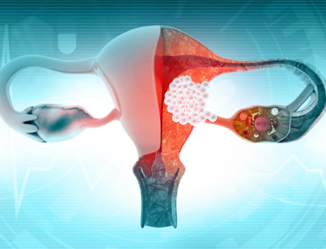 HPV : une seule dose de vaccin suffirait-elle ?