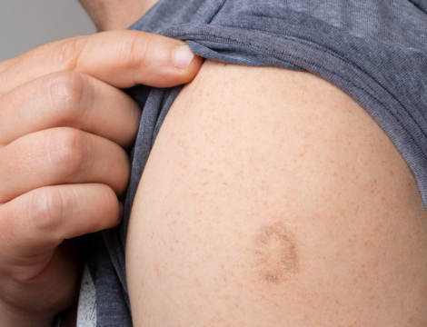 Variole du singe : les 6 points à connaître sur les vaccins disponibles