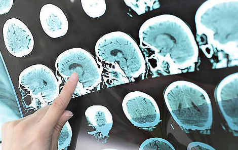 Sclérose en plaques : savoir, c’est pouvoir !