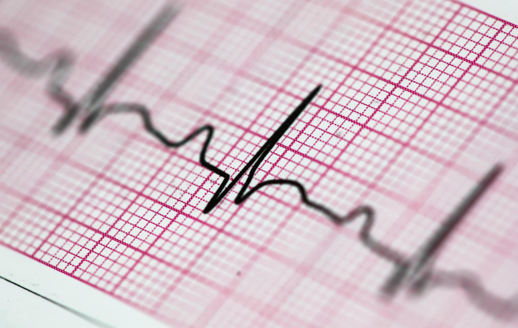 Citalopram et escitalopram : rester attentif à l&rsquo;allongement de l’intervalle QT