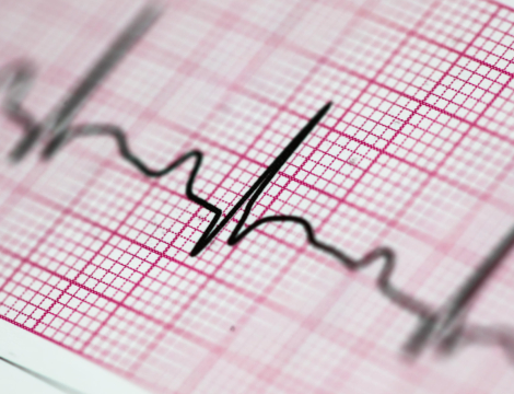 Citalopram et escitalopram : rester attentif à l&rsquo;allongement de l’intervalle QT