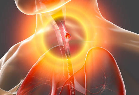 Œsophagite à éosinophiles : Jorveza indiqué en seconde intention