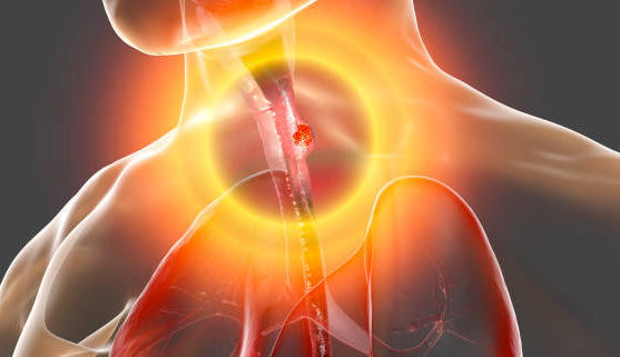 Œsophagite à éosinophiles : Jorveza indiqué en seconde intention