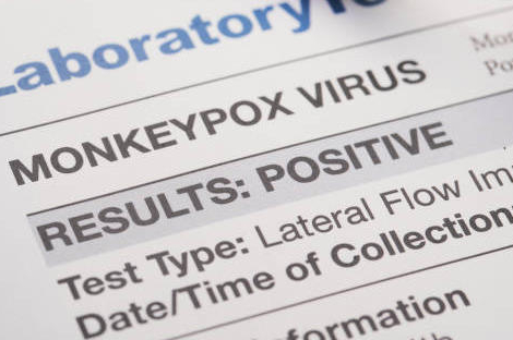 Monkeypox : vers un remboursement des tests ?