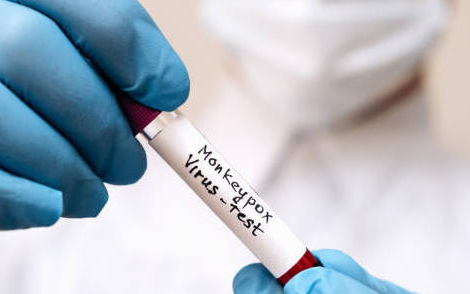 Monkeypox : le virus détecté dans le sang