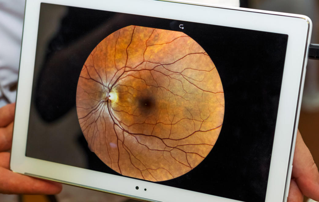 Visudyne : comment l’obtenir