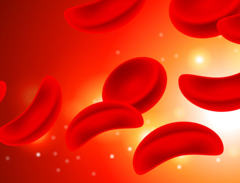 Drépanocytose : vers une généralisation du dépistage