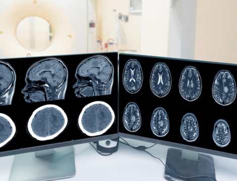 Acétate de cyprotérone : où en est-on avec les méningiomes ?