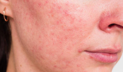 Rosacée : peut-elle s’accompagner de symptômes oculaires ?