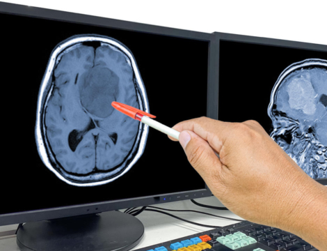 Progestatifs et méningiome : 3 nouvelles molécules incriminées et 3 autres innocentées​​​​​​