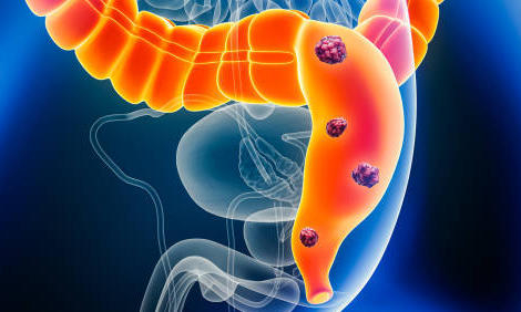 Dépistage du cancer colorectal : l&rsquo;officine joue le jeu de la prévention