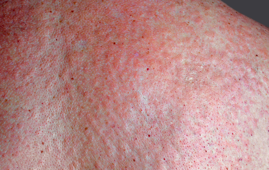 Lamotrigine et éruptions cutanées : l&rsquo;ANSM renouvelle son alerte