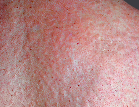 Lamotrigine et éruptions cutanées : l&rsquo;ANSM renouvelle son alerte