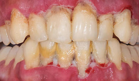 Maladie parodontale : une complication peu évoquée du diabète