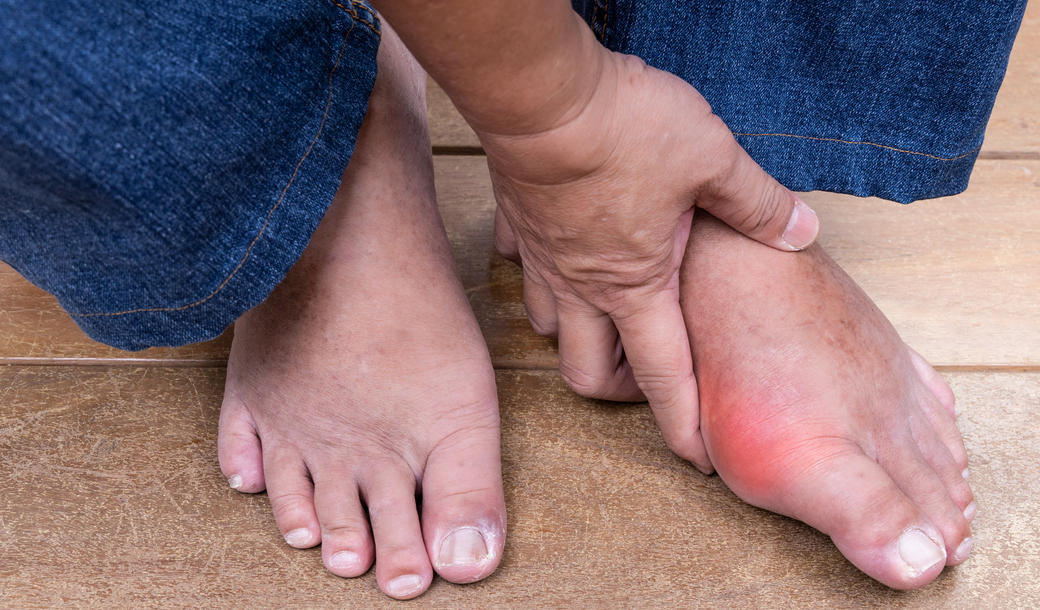 Allopurinol : pourquoi faut-il augmenter progressivement sa posologie ?