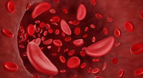 Drépanocytose : comment se traduit-elle ?
