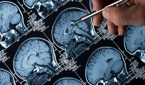 Médicaments antiépileptiques : les spécificités de la substitution