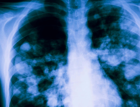 Recrudescence d’infections respiratoires à mycoplasme : les 5 points clés à connaître