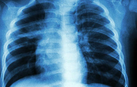 Tuberculose multirésistante : une nouvelle option de traitement