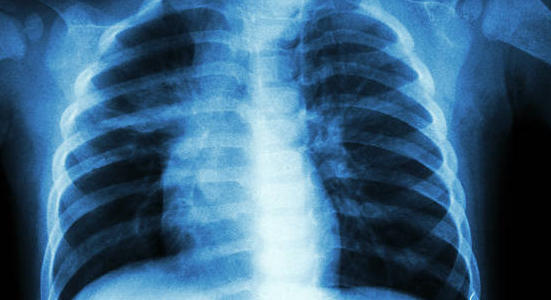 Tuberculose multirésistante : une nouvelle option de traitement