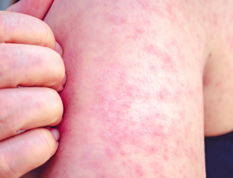 Vaccination contre la rougeole : des recommandations renforcées